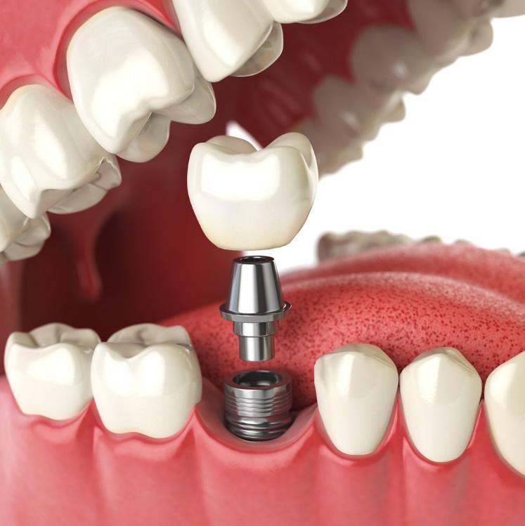 Quy trình phục hình răng sứ trên Implant