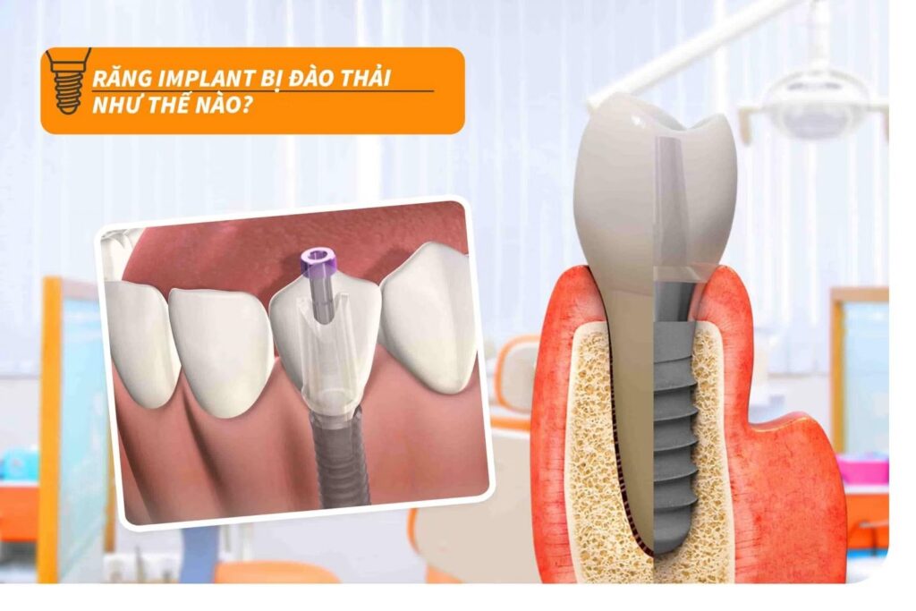 Răng implant bị đào thải