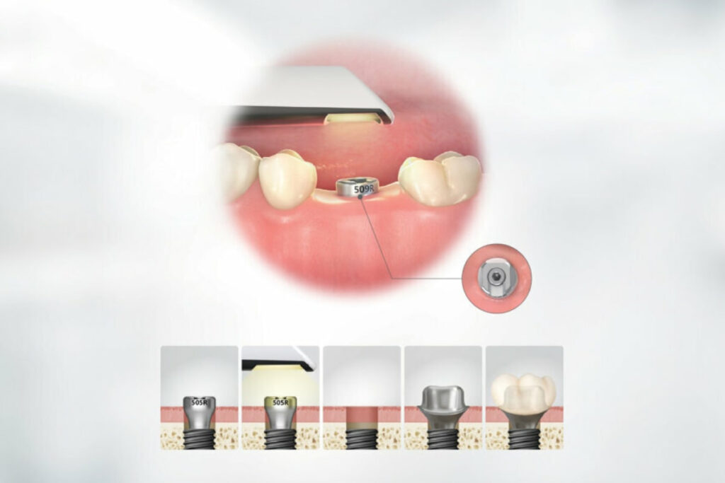 Thời gian để đặt Healing implant