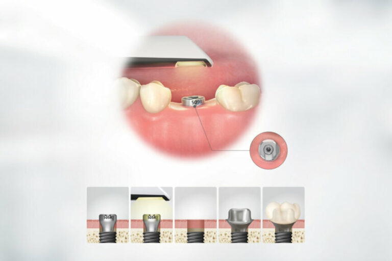 Thời gian để đặt Healing implant