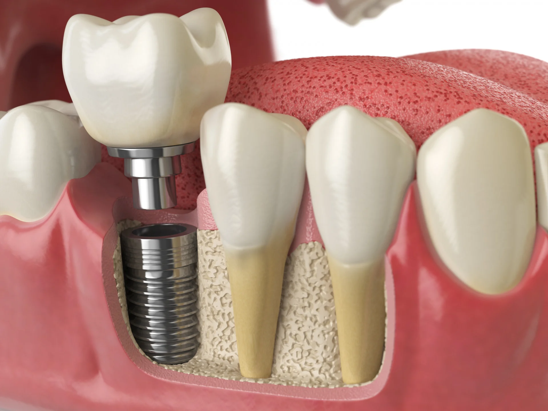 Trụ implant Straumann lành tính