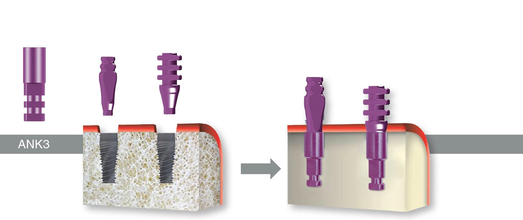 Các ứng dụng phổ biến của Implant Analog