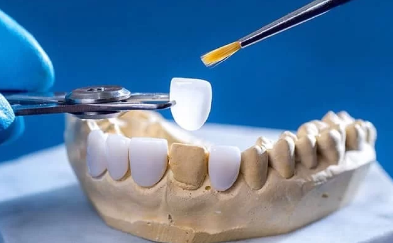 Phân loại keo dán răng sứ