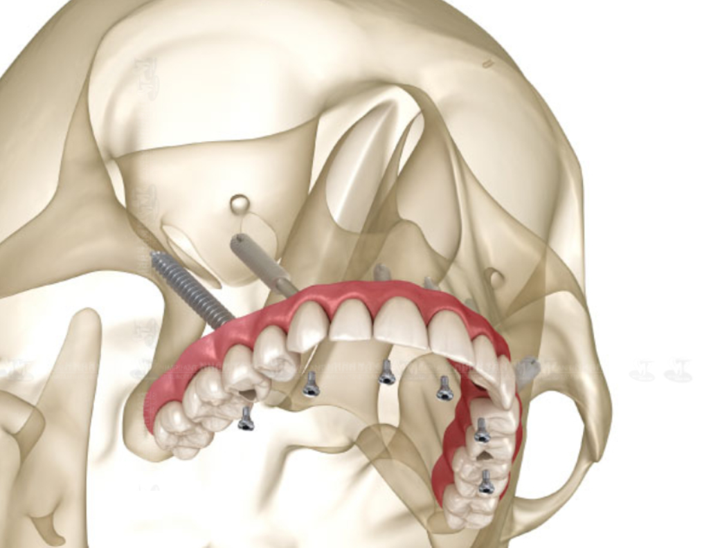 Thế nào là cấy ghép Implant chân bướm?