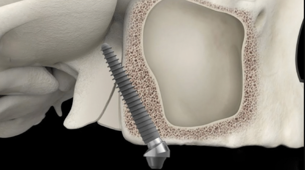 implant chân bướm
