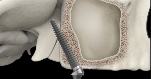 implant chân bướm
