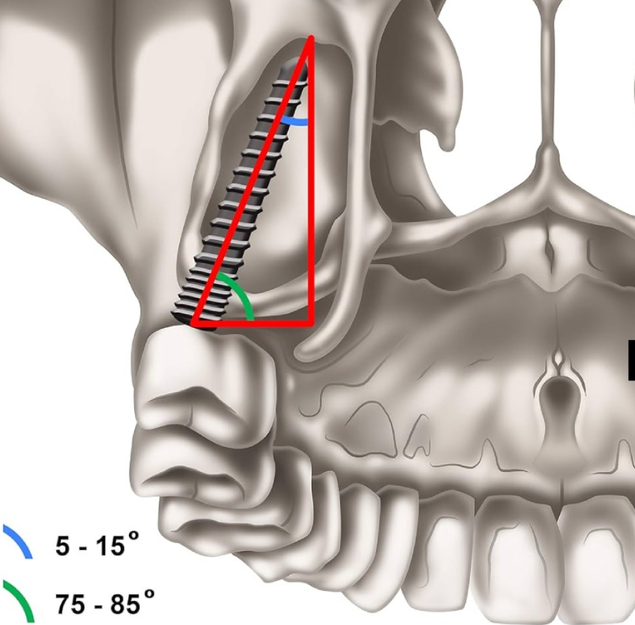 Nên lựa chọn Implant xương bướm hay Implant xương gò má?