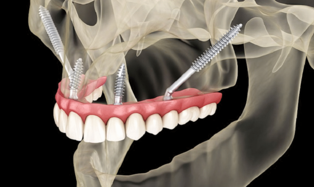 Cấy ghép Implant xương gò má 