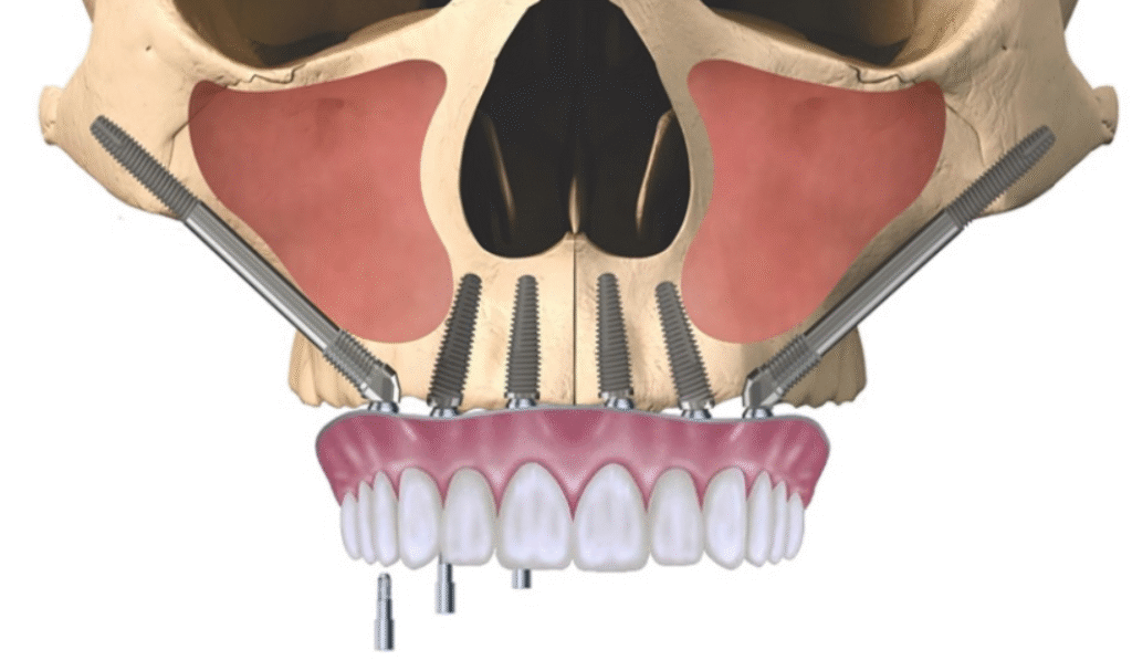 Ưu điểm của phương pháp cấy ghép Implant xương gò má 