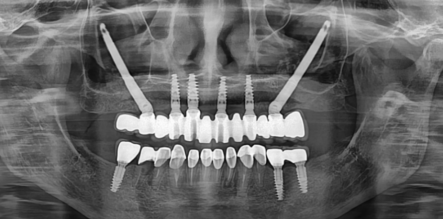Đối tượng phù hợp để cấy ghép Implant xương gò má 