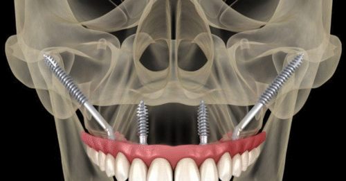 Implant xương gò má