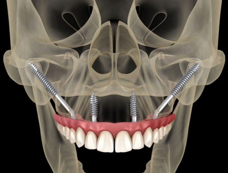 Implant xương gò má