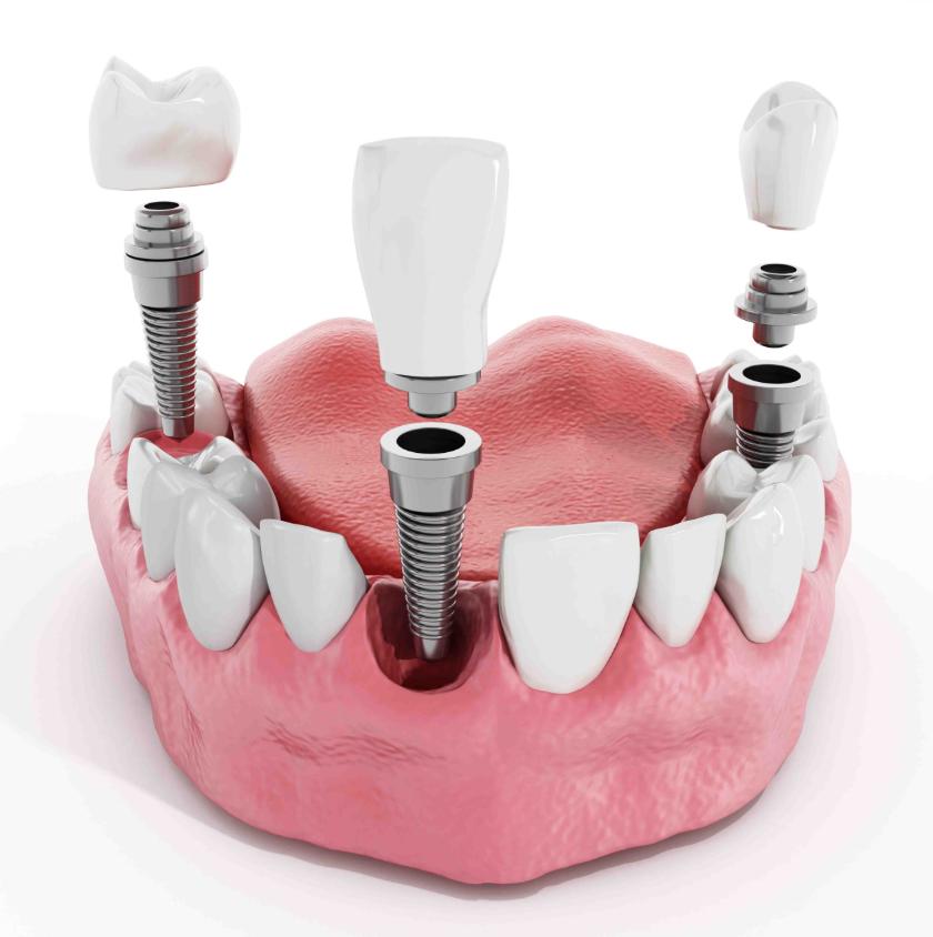 Ưu điểm của trụ Implant Superline Mỹ
