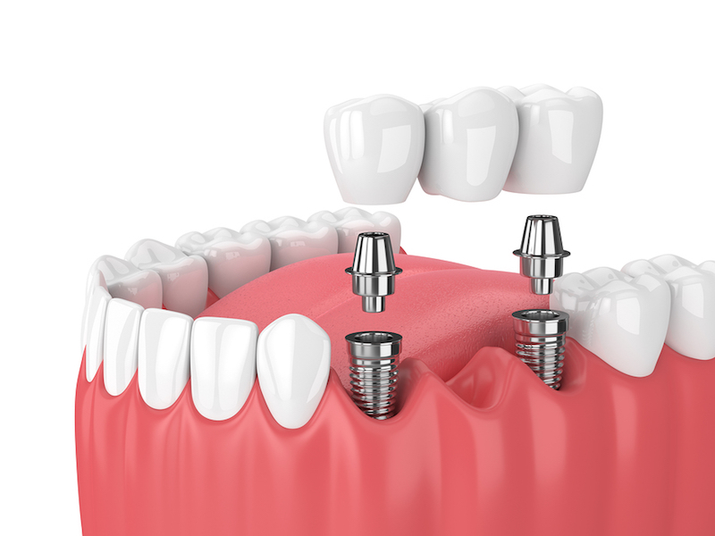 Tác động đến sự phân bố lực nhai
