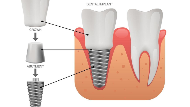 Các bộ phận cấu thành abutment