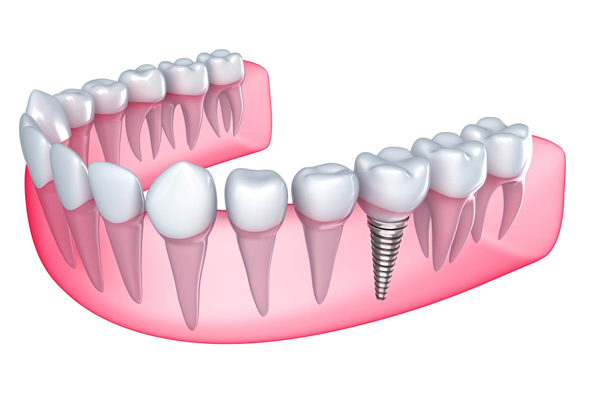 Ưu điểm của dòng Implant Dentium Hàn Quốc