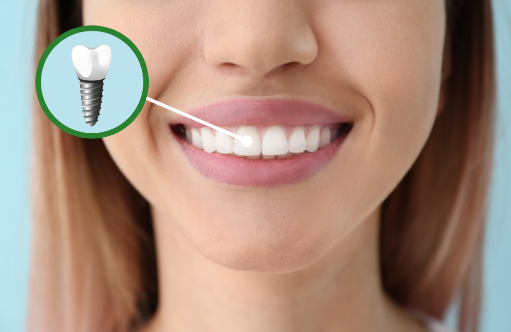 Ai phù hợp để cấy ghép Implant Dentium