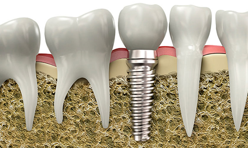 Phân loại abutment phổ biến
