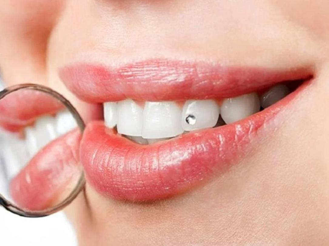 Ai nên bọc răng sứ Diamond