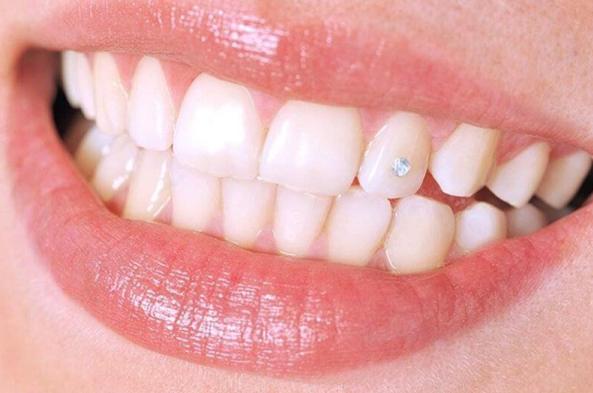 Răng sứ Diamond là gì? Của nước nào?