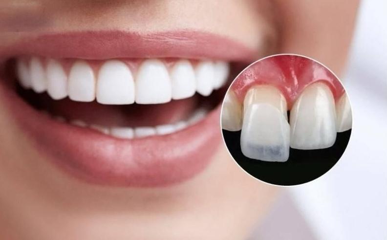 Dán sứ Veneer