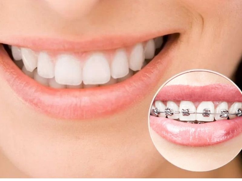 bọc răng sứ có niềng được không 