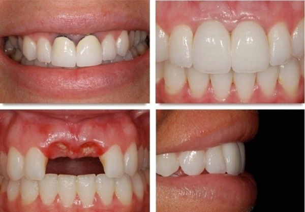 Mất Răng Lâu Năm Có Trồng Implant Được Không