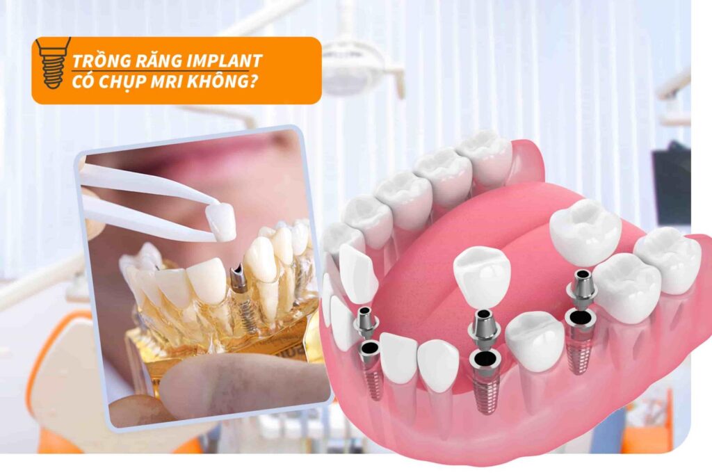 Trồng răng implant có chụp MRI được không?