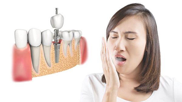 trồng răng implant có bị hôi miệng không 