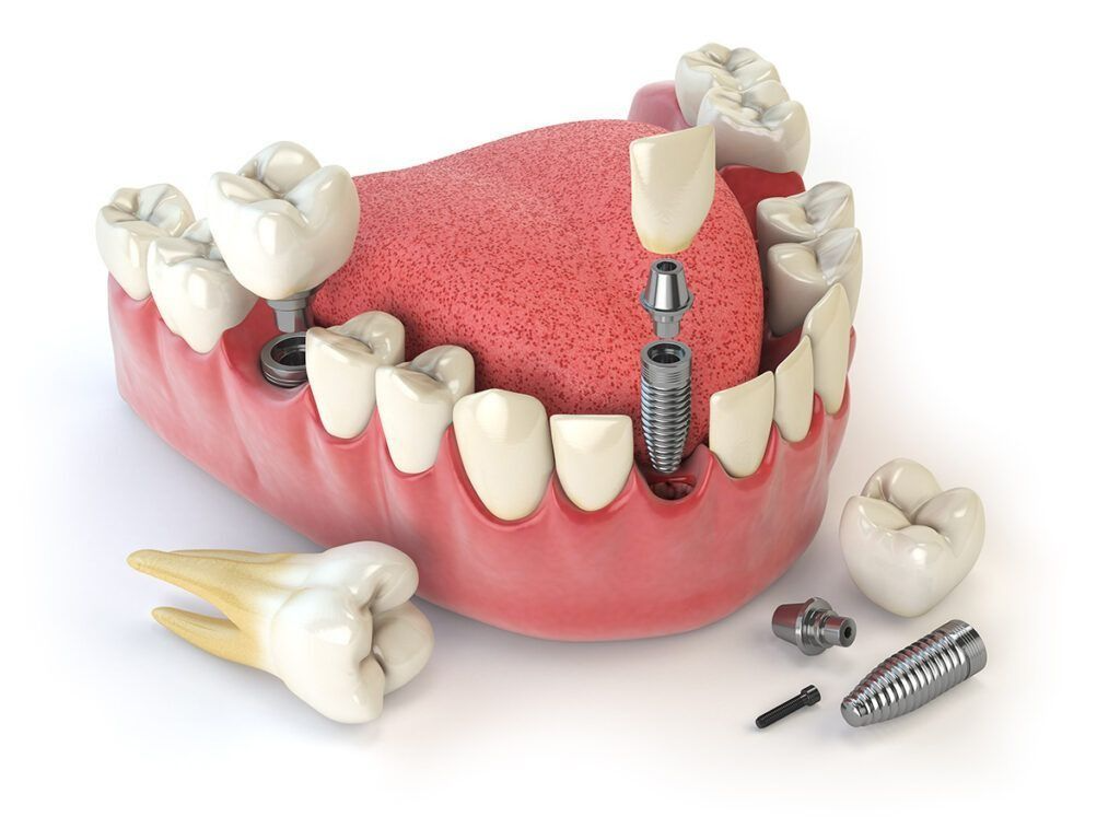trụ implant sic 