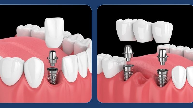 implant tekka pháp 
