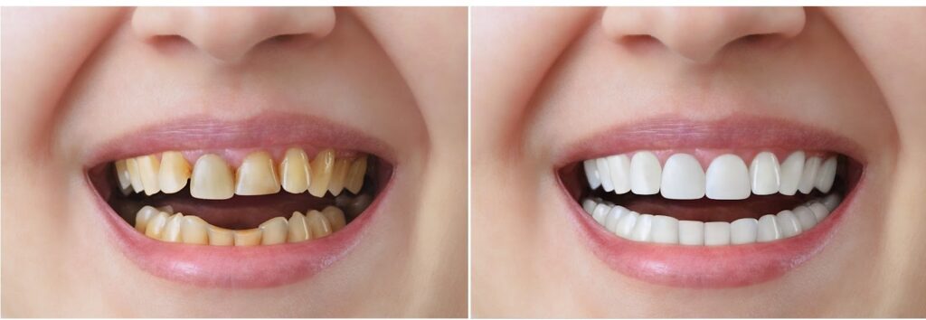 Bọc Răng Sứ Có Niềng Được Không?