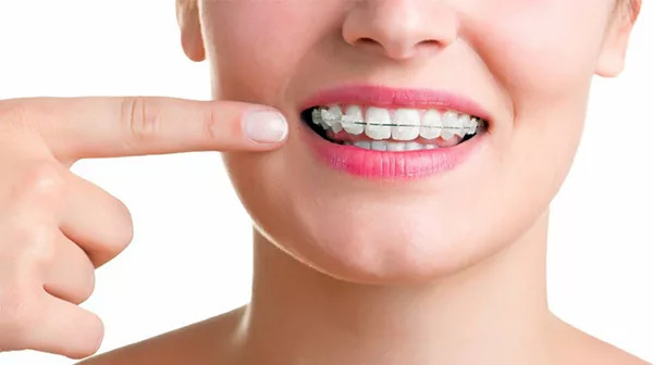 Răng sứ chịu được lực kéo khi niềng