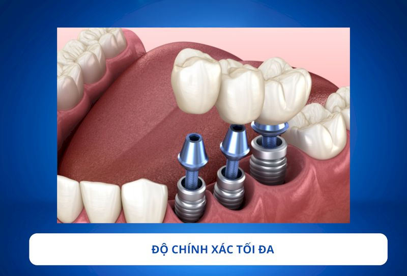 Trụ MIS C1 Có Tốt Không?