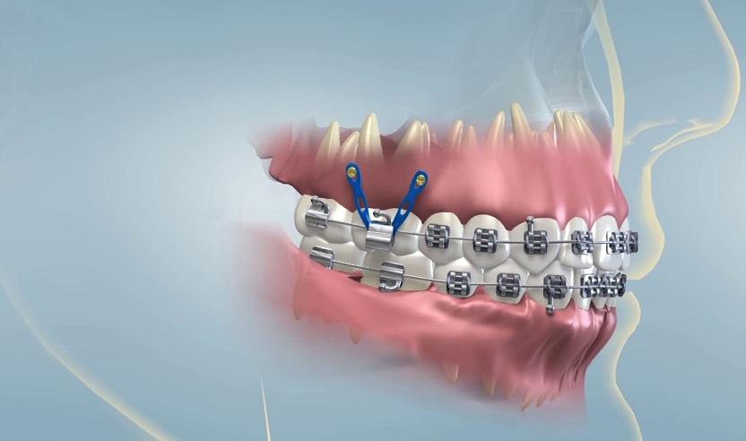 Trường hợp nên bắt vít niềng răng