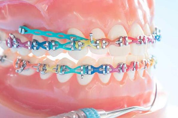 Bắt vít niềng răng có đau không