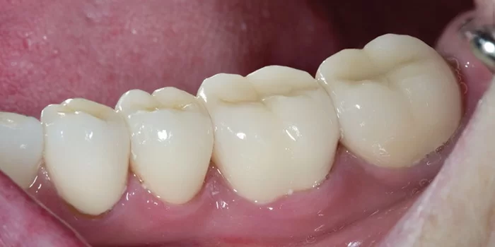 Giá răng sứ Zolid