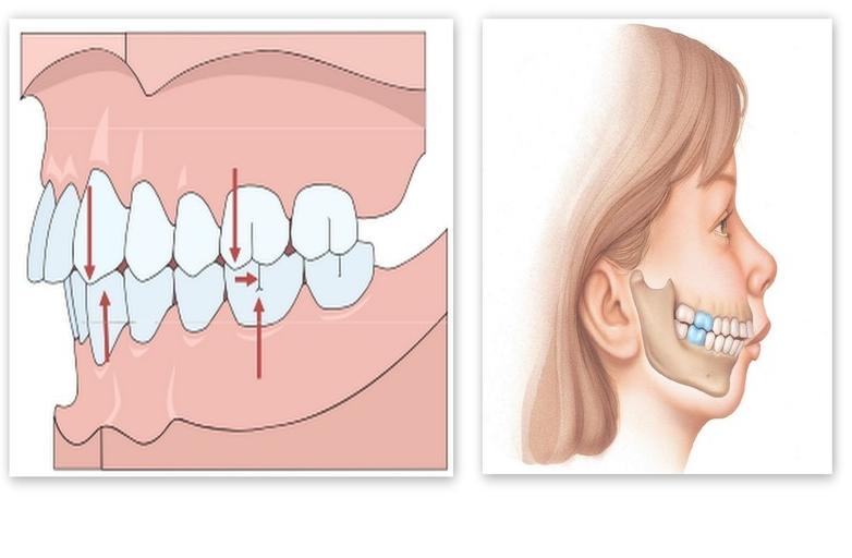Tình trạng răng miệng và độ sai lệch của răng