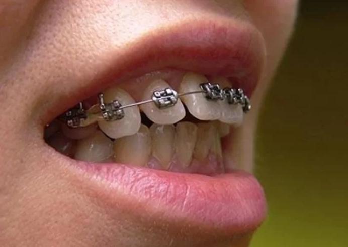 Niềng răng hô mất bao lâu