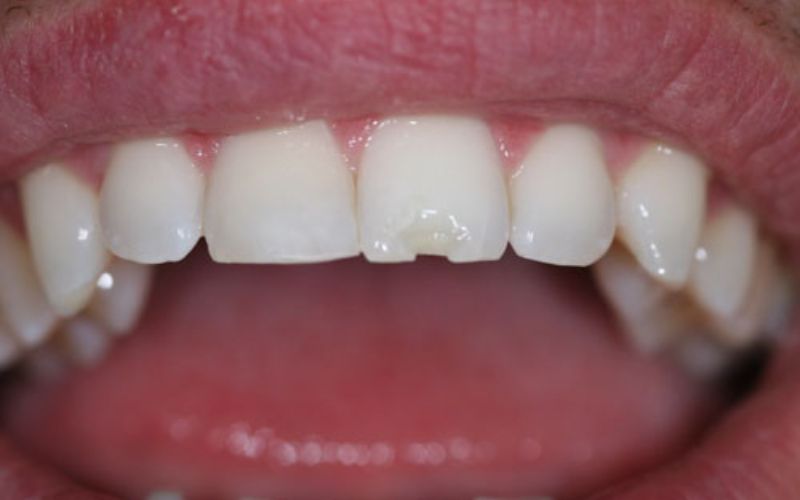 Nguyên nhân khiến răng sứ bị mẻ