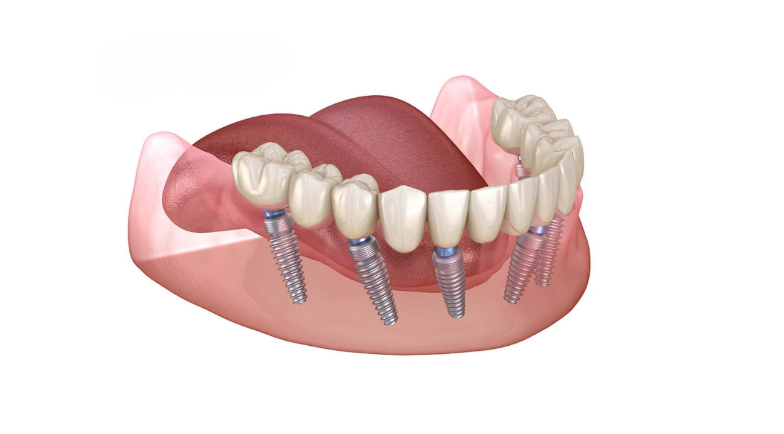 Trụ Implant DIO Là Gì?