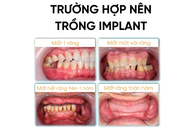 Trường hợp nên dùng Trụ Implant Kontact 