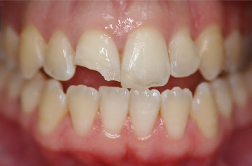 Có nên bọc răng sứ cho răng cửa bị mẻ không