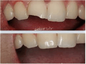 Có nên bọc sứ cho răng cửa bị mẻ không