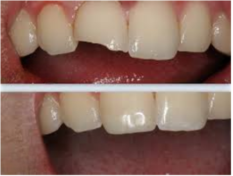 Bọc răng sứ cho răng của bị mẻ có đâu không? 