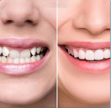 Quy trình bọc sứ răng khểnh như thế nào