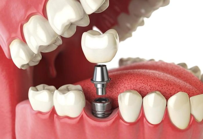 Trụ Implant DIO