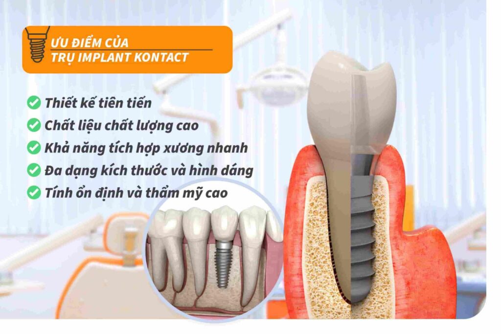 Ưu điểm của Trụ Implant Kontact