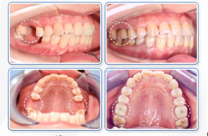 Trước và sau khi làm trụ IMPLANT DIO