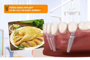 trồng răng implant có ăn được thịt gà không